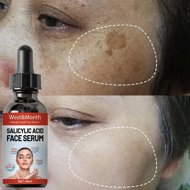 Licorice Root Extract - Powerful Dark Spots Remover Freckle Whitening